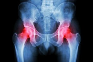障害年金を大腿骨骨頭壊死症でもらうためのポイントと４つの手順
